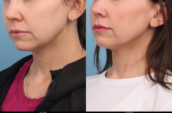 L.Boston-Ultherpy-Lower-Face-Upper-Neck-3