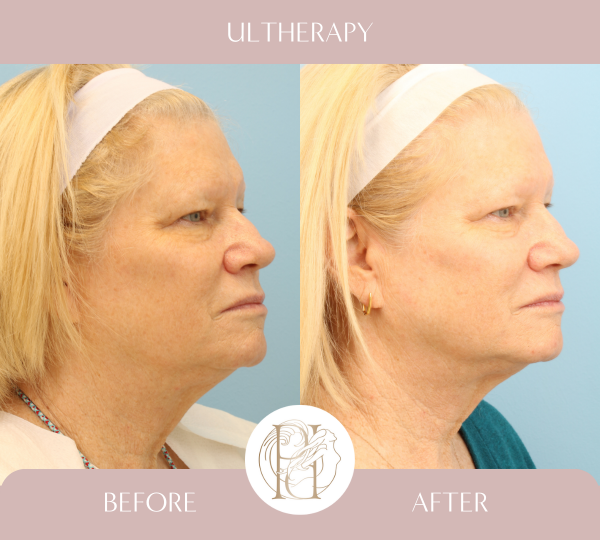 Ulthera Full Face, Ulthera Full Neck, Ulthera Perioral, Ultrapulse Upper & Lower Eyelids