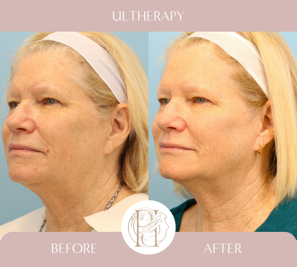 Ulthera Full Face, Ulthera Full Neck, Ulthera Perioral, Ultrapulse Upper & Lower Eyelids