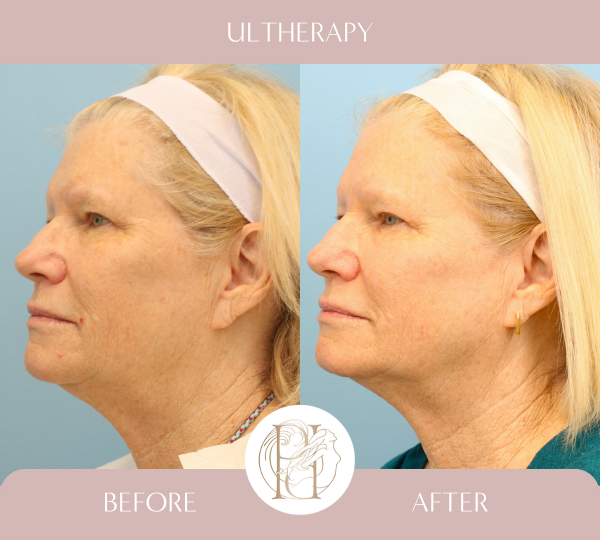 Ulthera Full Face, Ulthera Full Neck, Ulthera Perioral, Ultrapulse Upper & Lower Eyelids