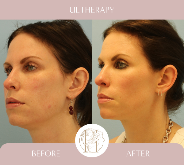 Ulthera - Lower face and upper neck