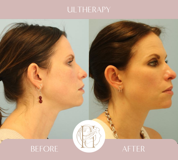 Ulthera - Lower face and upper neck