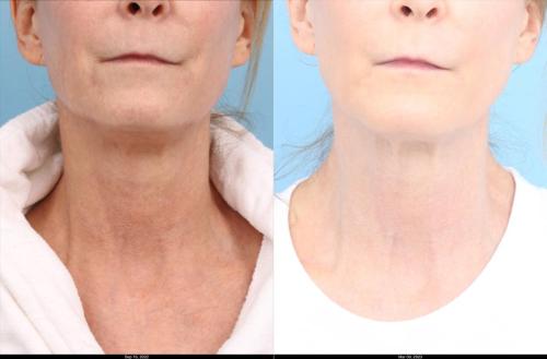 Ultherapy Full Neck