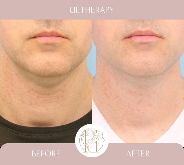 Ultherapy Full Neck