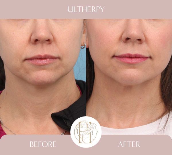 Ultherpy Lower Face + Upper Neck 1 of 3 Treatments