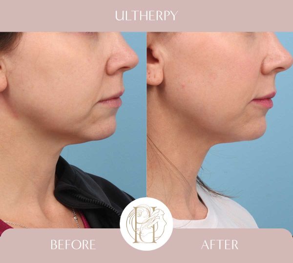 Ultherpy Lower Face + Upper Neck 2 of 3 Treatments