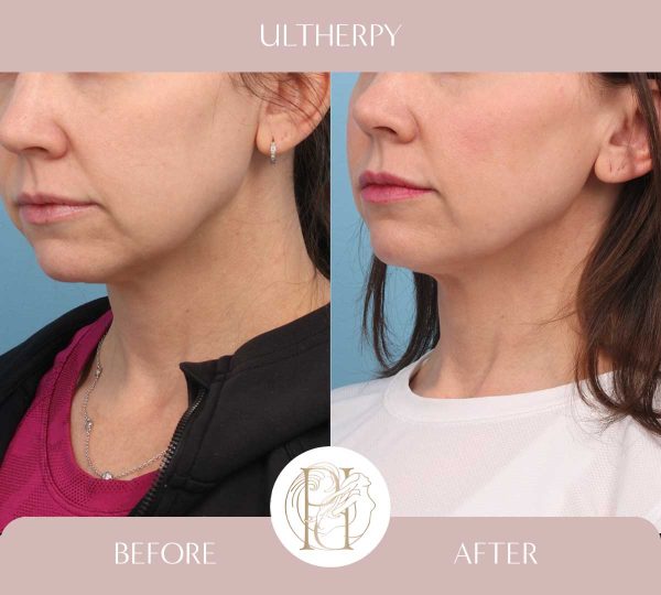 Ultherpy Lower Face + Upper Neck 3 of 3 Treatments