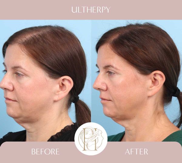 Full Face + Upper Neck 1 of 3