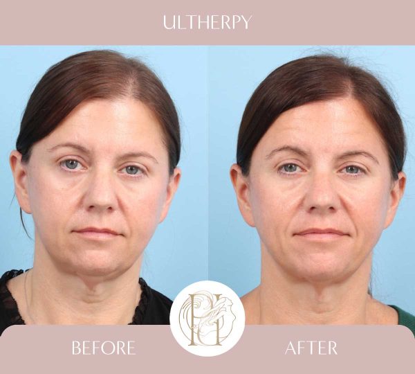 Full Face + Upper Neck 2 of 3