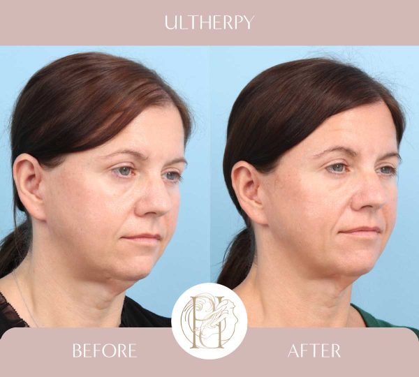 Full Face + Upper Neck 3 of 3