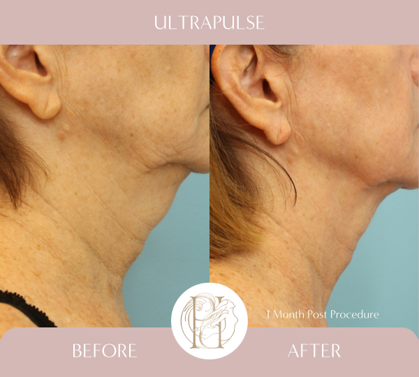 Ultrapulse (Full Face, Neck, Eyelids, Chest)