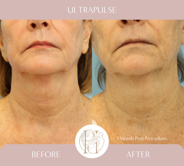 Ultrapulse (Full Face, Neck, Eyelids, Chest)