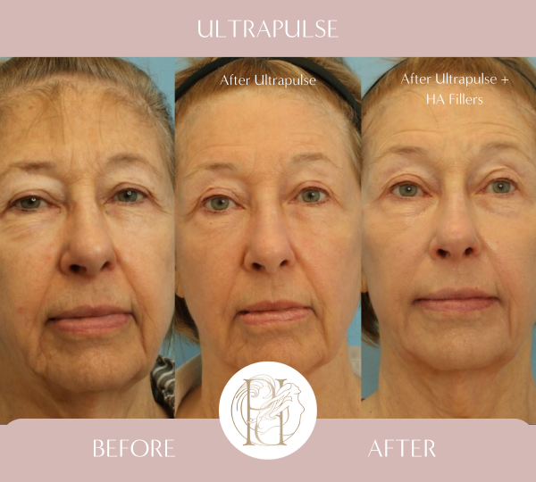 Utlrapulse (Face, Neck, Chest, Eyelids). Client also recieved two Syringes of Voluma (Cheeks) Two Syringes of Restalyne Defyne (Marrionette Lines) and Botox (Crows-feet, Glabella, Perioral)