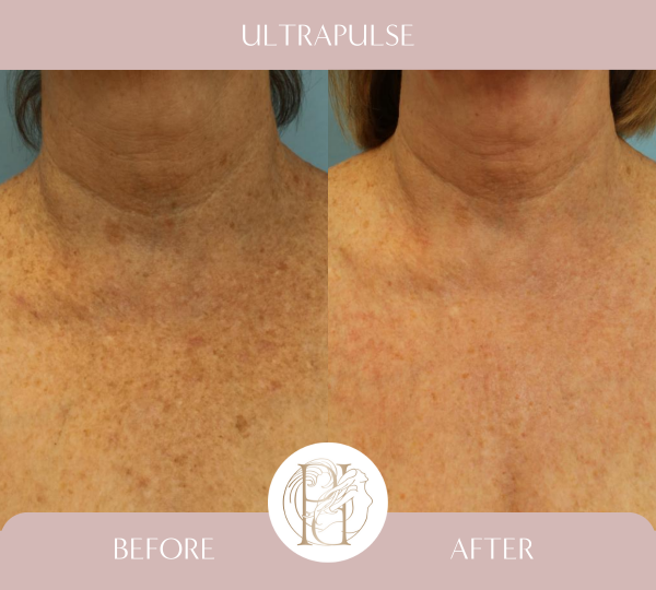 Ultrapulse (Full Face, Neck, Eyelids, Chest)