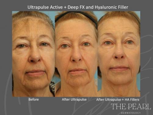 Utlrapulse (Face, Neck, Chest, Eyelids). Client also recieved two Syringes of Voluma (Cheeks) Two Syringes of Restalyne Defyne (Marrionette Lines) and Botox (Crows-feet, Glabella, Perioral)