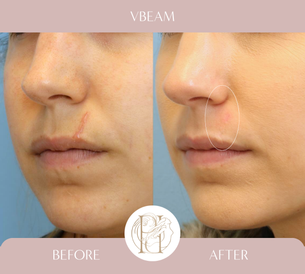 Patient had 6 Vbeam (PDL) and 4 ResurFx to the upper lip scar