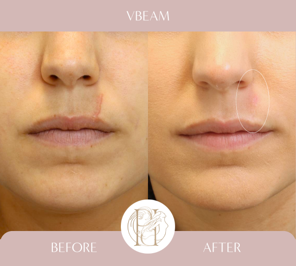 Patient had 6 Vbeam (PDL) and 4 ResurFx to the upper lip scar