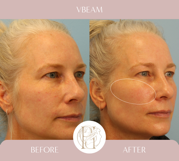 Patient had her full face treated 4 times with the Vbeam PDL (Pulsed Dye laser)