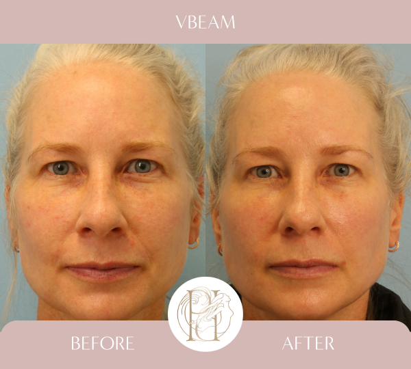 Patient had her full face treated 4 times with the Vbeam PDL (Pulsed Dye laser)