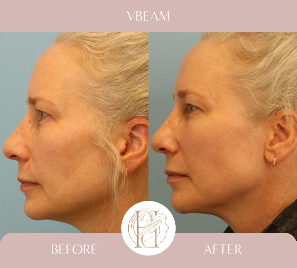 Patient had her full face treated 4 times with the Vbeam PDL (Pulsed Dye laser)