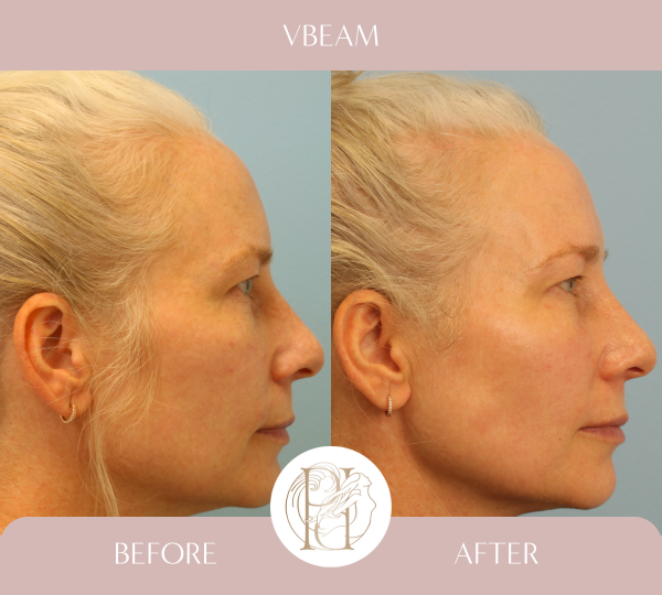 Patient had her full face treated 4 times with the Vbeam PDL (Pulsed Dye laser)