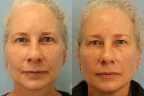 Patient had her full face treated 4 times with the Vbeam PDL (Pulsed Dye laser)