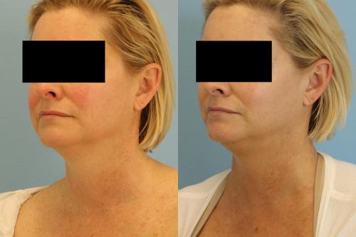 3 Treatments of IPL (Photofacial) for face, neck and chest