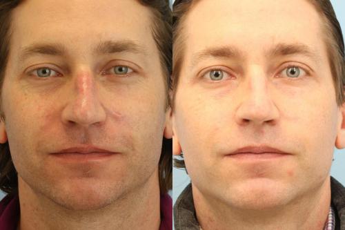 Patient had 3 photofractional (IPL + ResurFx) for cheeks & nose.