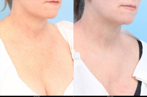 Received 3 treatments of the IPL on her face, neck, and chest