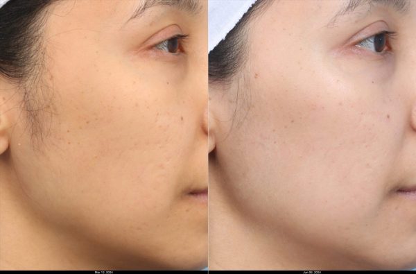 K.Calalang-Morpheus-Cheeks-3-treatments-1