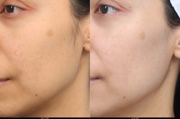K.Calalang-Morpheus-Cheeks-3-treatments-2 (1)