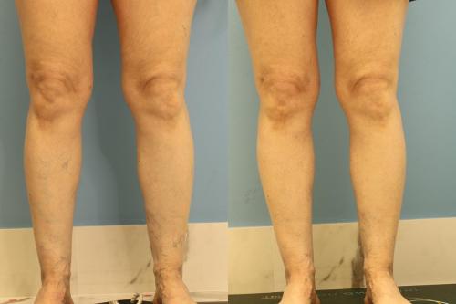 Client had two treatments of Sclerotherapy