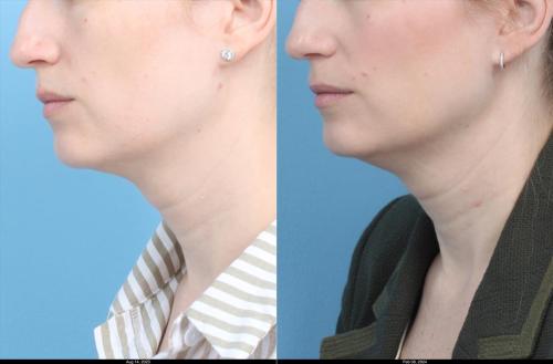 Ultherapy Full Neck